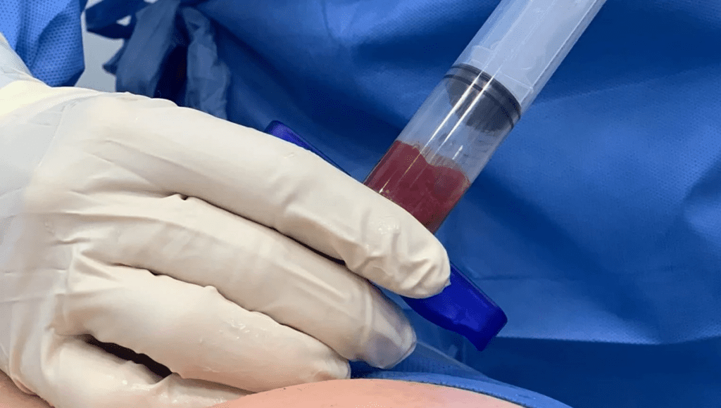 stemcellsbeingadded Stem cell injections have shown promise in addressing a range of conditions. Early research indicates potential benefits for conditions such as joint pain (including osteoarthritis), rotator cuff tears, and spinal cord injuries.